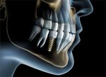 dental-implant-treatment.jpg