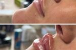 img-botox-1024x682.jpg